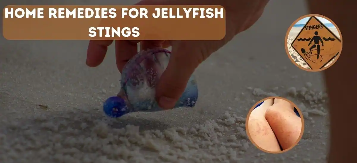 How to Treat Jellyfish Stings: Best Home Remedies